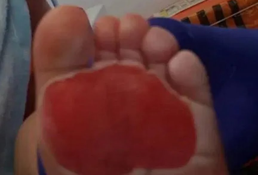 Un bebé se quema los pies al pisar las baldosas de la cocina por ola de calor en Inglaterra (FOTOS)