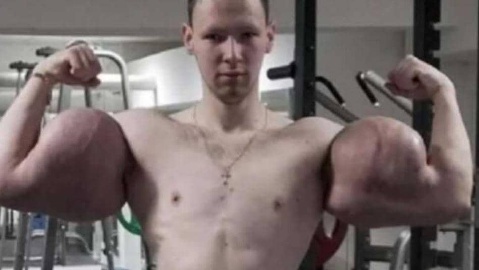 El llamado ‘Popeye Ruso’ se le explotó un brazo en pleno combate por inyectarse aceite (VIDEO)