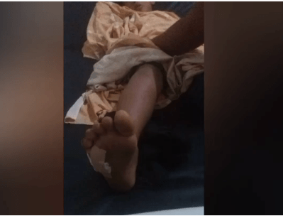 Culebra muerde a niño en Bachaquero y necesita con suma urgencia suero antiofídico