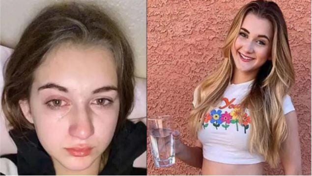 El extraño caso de la joven que es alérgica al agua