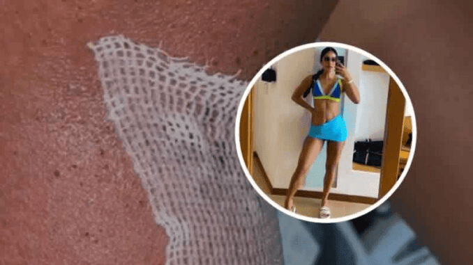 Una joven de Medellín asegura que se le pegó una bacteria en el gym por no limpiar la máquina