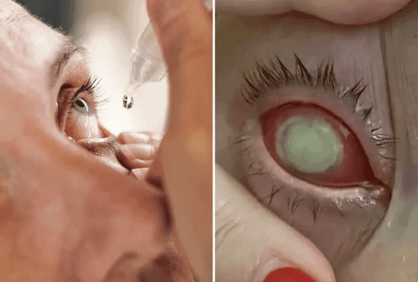 Gotas para los ojos generan alarma en EEUU: provocó la muerte de una persona y ocho más perdieron la vista