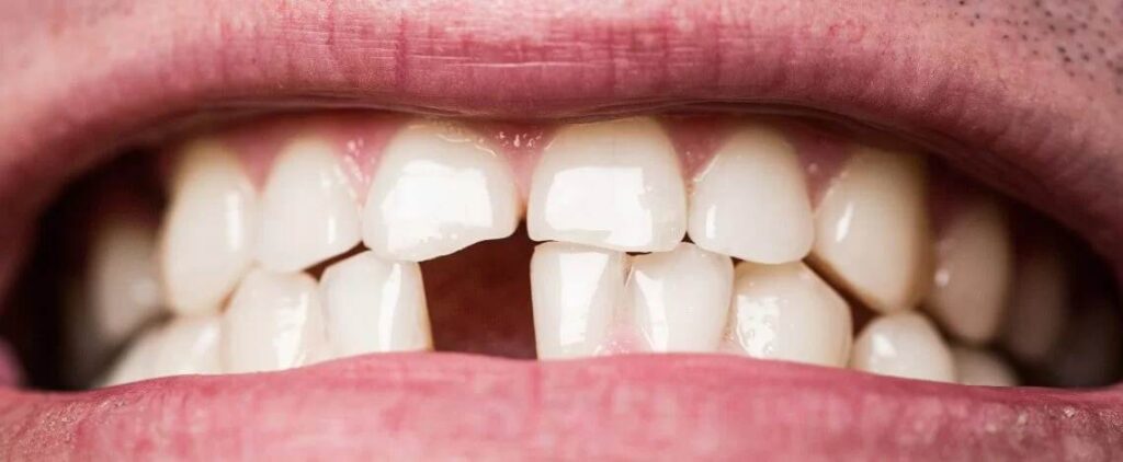 Finalmente revelaron qué significa soñar que se te caen los dientes
