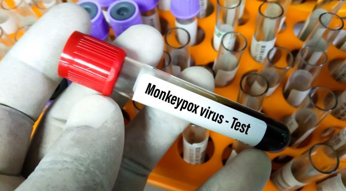 Honduras investiga cinco supuestos casos de nueva variante de la viruela del mono