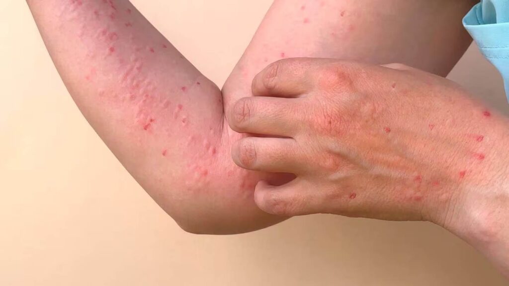 Latinoamérica aún no reporta casos de nueva variante de mpox y activa planes de vigilancia