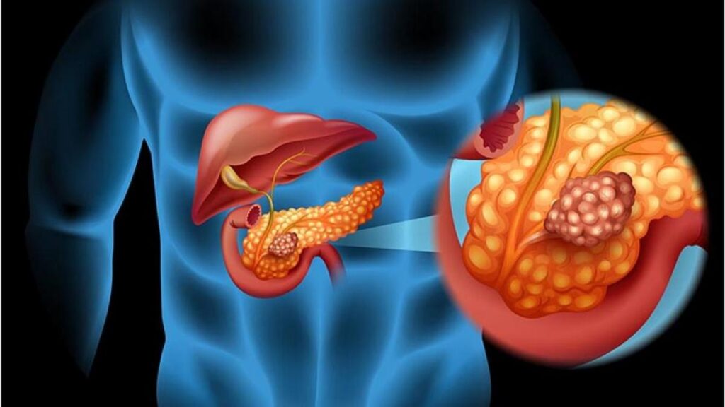 cáncer pancreas