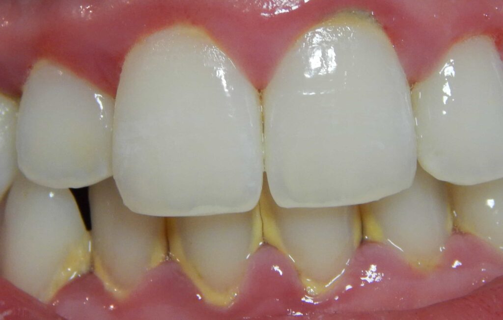 ¡TRUCO CASERO! Elimine el sarro dental desde casa Sarro dental