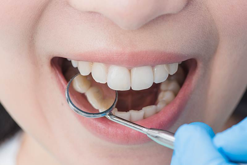 El remedio más natural y fácil para quitar el sarro de los dientes remedio natural