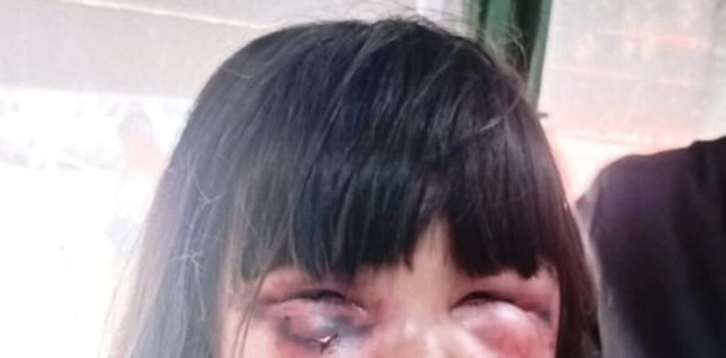 ¡COBARDE! Padrastro propina fuerte golpiza a la hija de su novia sin razón aparente (FOTO DESGARRADORA) Niña golpeada por su padrastro