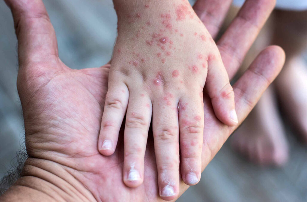 Alarma sanitaria en EE.UU.: Nueva York declara la emergencia por sarampión y Pensilvania supera los 1.000 contagios